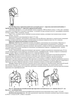 Рис. 66. Переломы в проксимальной части плечевой кости: 1 - переломы анатомической шейки; 2 -
чрезбугорковые переломы; 3 - переломы хирургической шейки
седативные препараты, с 3-го дня начинают магни-тотерапию, УВЧ на область плеча, с 7-10-го дня - активные
движения в лучезапястном и локтевом и пассивные - в плечевом суставе (съемная лонгета!), электрофорез новокаина,
кальция хлорида, УФО, ультразвук, массаж.
Через 4 нед. гипсовую лонгету заменяют на косы-ночную повязку, усиливают восстановительное лечение.
Реабилитация - до 5 нед.
Трудоспособность восстанавливается через 2- 2!
/2 мес.
Показания к операции: невозможность репозиции при нестабильных переломах со значительным смещением
отломков, интерпозиция мягких тканей и осколков между суставными поверхностями (тип A3 и тяжелее).
Переломы хирургической шейки плечевой кости.
Причины. Переломы без смещения отломков, как правило, вколоченные или сколоченные. Переломы со
смещением отломков в зависимости от их положения делятся на приводящие (аддукционные) и отводящие
(абдукционные). Аддукционные переломы возникают при падении с упором на вытянутую приведенную руку. При
этом проксимальный отломок оказывается отведенным и ротированным кнаружи, а периферический - смещен
кнаружи, вперед и ротирован
внутрь. Абдукционные переломы возникают при падении с упором на вытянутую отведенную руку. В этих
случаях центральный отломок приведен и ротирован кнутри, а периферический - кнутри и кпереди со смещением
вперед и кверху. Между отломками образуется угол, открытый кнаружи и кзади.
Признаки. При вколоченных переломах и переломах без смещения определяется местная болезненность,
усиливающаяся при нагрузке по оси конечности и ротации плеча, функция плечевого сустава возможна, но
ограничена. При пассивном отведении и ротации плеча головка следует за диафизом. На рентгенограмме
определяется угловое смещение отломков. При переломах со смещением отломков основными признаками являются
резкая боль, нарушение функции плечевого сустава, патологическая подвижность на уровне перелома, укорочение и
нарушение оси плеча. Характер перелома и степень смещения отломков уточняют рентгенографически.
Лечение. Первая помощь включает введение анальгетиков (промедол), иммобилизацию транспортной шиной
или повязкой Дезо (рис. 67), госпитализацию в травматологический стационар, где осуществляют полное
обследование, обезболивание места перелома, репозицию и иммобилизацию конечности лонгетой (при вколоченных
переломах) или торакобрахиальной
Рис. 67. Транспортная иммобилизация при переломах плечевой кости: а, б - повязка Дезо (1-5 - ход
бинта); в - лестничная шина
повязкой с обязательным рентгенографическим контролем после высыхания гипса и через 7-10 дней.
Особенности репозиции (рис. 68): при аддукционных переломах помощник поднимает руку больного вперед
на 30-45° и отводит на 90°, сгибает в локтевом
 