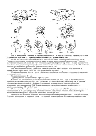 Рис. 68. Репозиция и удержание отломков плечевой кости: а, б - при абдукционных переломах; в-д - при
аддукционных переломах; е - торакобрахиальная повязка; ж - лечение по Каштану
суставе до 90°, ротирует плечо кнаружи на 90° и постепенно плавно производит вытяжение по оси плеча.
Травматолог контролирует репозицию и проводит корригирующие манипуляции в области перелома. Тяга по оси
плеча должна быть сильной, иногда для этого помощник осуществляет противоупор стопой в область подмышечной
ямки. После этого руку фиксируют торакобрахиаль-ной повязкой в положении отведения плеча до 90-100°, сгибания в
локтевом суставе до 80-90°, разгибания в лучезапястном суставе до 160°.
При абдукционных переломах травматолог руками исправляет угловое смещение, затем репозицию и
иммобилизацию осуществляют так же, как и при аддукционных переломах.
Сроки иммобилизации - от 6 до 8 нед., с 5-й недели плечевой сустав освобождают от фиксации, оставляя руку
на отводящей шине.
Сроки реабилитации - 3-4 нед.
Трудоспособность восстанавливается через 2-21
/2 мес.
С первого дня иммобилизации больные должны активно двигать пальцами и кистью. После превращения
циркулярной повязки в лонгетную (через 4 нед.) разрешают пассивные движения в локтевом суставе (с помощью
здоровой руки), а еще через неделю - активные. Одновременно назначают массаж и механотерапию (для
дозированной нагрузки на мышцы). ЛФК больные занимаются ежедневно под руководством методиста и
самостоятельно каждые 2-3 ч по 20-30 мин.
После того как больной сможет многократно поднимать руку над шиной на 30-45° и удерживать конечность в
этом положении 20-30 с, отводящую шину снимают и начинают реабилитацию в полном объеме. Если закрытая
репозиция отломков не удается, то показано оперативное лечение (рис. 69).
После открытой репозиции выполняют фиксацию отломков стягивающими шурупами с Т-образной пластиной.
Если кость остеопорозна, то применяют спицы и стягивающий проволочный шов. Четырехфрагментные переломы
 