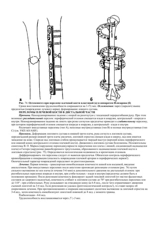 Рис. 74. Остеосинтез при переломе плечевой кости пластиной (а) и аппаратом Илизарова (б)
Сроки восстановления трудоспособности сокращаются на 1-1
/2 мес. Осложнения: парез (паралич) мышц
предплечья (повреждение лучевого нерва), формирование ложного сустава.
ПЕРЕЛОМЫ ПЛЕЧЕВОЙ КОСТИ В ДИСТАЛЬНОЙ ЧАСТИ
Причины. Некоординированное падение с опорой на разогнутую с тенденцией переразгибания руку. При этом
возникает разгибательный перелом: периферический отломок смещается кзади и кнаружи, центральный - кпереди и
кнутри. Некоординированное падение на локоть при резко согнутом предплечье приводит к сгибательному перелому,
при котором периферический отломок смещается кпереди и кнаружи, а центральный - кзади и кнутри.
Различают внесуставные переломы (тип А), неполные внутрисуставные (тип В) и полные внутрисуставные (тип
С) (см. УКП AO/ASIF).
Признаки. Деформация локтевого сустава и нижней трети плеча, рука согнута в локтевом суставе,
переднезадний размер нижней трети плеча увеличен, локтевой отросток смещен кзади и кверху, над ним имеется
западение на коже. Спереди над локтевым сгибом прощупывается твердый выступ (верхний конец периферического
или нижний конец центрального отломка плечевой кости). Движения в локтевом суставе болезненны. Положительны
симптомы В. О. Маркса (нарушение перпендикулярности пересечения оси плеча с линией, соединяющей надмыщелки
плеча) и Гютера (нарушение равнобедренного треугольника, образованного надмыщелками плечевой кости и
локтевым отростком) (рис. 75). Определяются патологическая подвижность и крепитация отломков.
Дифференцировать эти переломы следует от вывихов предплечья. Обязателен контроль периферического
кровообращения и иннервации (опасность повреждения плечевой артерии и периферических нервов!).
Окончательный характер повреждений определяют по рентгенограммам.
Лечение. Первая помощь - транспортная иммобилизация конечности шиной или косынкой, введение
анальгетиков. При внесуставных переломах после анестезии производят репозицию отломков (рис. 76) путем
сильного вытяжения по оси плеча (в течение 5-6 мин) и дополнительного давления на дистальный отломок: при
разгибательных переломах кпереди и кнутри, при сгиба-тельных - кзади и кнутри (предплечье должно быть в
положении пронации). После репозиции конечность фиксируют задней гипсовой лонгетой (от пястно-фаланговых
суставов до здорового надплечья), конечность сгибают в локтевом суставе до 70° при разгибательных переломах или
до 110° - при сгибательных. Руку укладывают на отводящую шину на 6-8 нед., после чего ограничивают движения
съемной лонгетой на 3-4 нед. Если репозиция не удалась (рентгенологический контроль!), то ставят вопрос об
оперативном лечении. При противопоказаниях к операции накладывают скелетное вытяжение за локтевой отросток на
3-4 нед., затем конечность иммобилизуют лонгетной повязкой до 8 нед. с момента травмы.
Реабилитация - 4-6 нед.
Трудоспособность восстанавливается через 21
/2-3 мес.
 