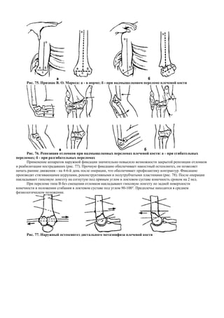 Рис. 75. Признак В. О. Маркса: а - в норме; б - при надмыщелковом переломе плечевой кости
Рис. 76. Репозиция отломков при надмыщелковых переломах плечевой кости: а - при сгибательных
переломах; б - при разгибательных переломах
Применение аппаратов наружной фиксации значительно повысило возможности закрытой репозиции отломков
и реабилитации пострадавших (рис. 77). Прочную фиксацию обеспечивает накостный остеосинтез, он позволяет
начать ранние движения - на 4-6-й день после операции, что обеспечивает профилактику контрактур. Фиксацию
производят стягивающими шурупами, реконструктивными и полутрубчатыми пластинами (рис. 78). После операции
накладывают гипсовую лонгету на согнутую под прямым углом в локтевом суставе конечность сроком на 2 нед.
При переломе типа В без смещения отломков накладывают гипсовую лонгету по задней поверхности
конечности в положении сгибания в локтевом суставе под углом 90-100°. Предплечье находится в среднем
физиологическом положении.
Рис. 77. Наружный остеосинтез дистального метаэпифиза плечевой кости
 