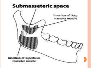 Submasseter Space Space infection in dental practice | PPTX