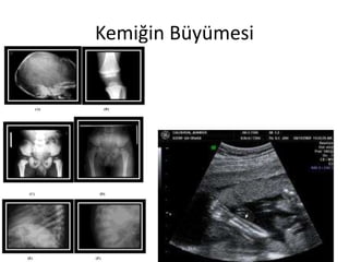 Kemiğin Büyümesi
 