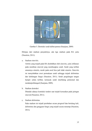 15
Gambar 5. Destruksi sendi akibat pannus (Suarjana, 2009)
Ditinjau dari stadium penyakitnya, ada tiga stadium pada RA yaitu
(Nasution, 2011):
a. Stadium sinovitis.
Artritis yang terjadi pada RA disebabkan oleh sinovitis, yaitu inflamasi
pada membran sinovial yang membungkus sendi. Sendi yang terlibat
umumnya simetris, meski pada awal bisa jadi tidak simetris. Sinovitis
ini menyebabkan erosi permukaan sendi sehingga terjadi deformitas
dan kehilangan fungsi (Nasution, 2011). Sendi pergelangan tangan
hampir selalu terlibat, termasuk sendi interfalang proksimal dan
metakarpofalangeal (Suarjana, 2009).
b. Stadium destruksi
Ditandai adanya kontraksi tendon saat terjadi kerusakan pada jaringan
sinovial (Nasution, 2011).
c. Stadium deformitas
Pada stadium ini terjadi perubahan secara progresif dan berulang kali,
deformitas dan gangguan fungsi yang terjadi secara menetap (Nasution,
2011).
 