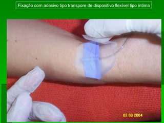 Fixação com adesivo tipo transpore de dispositivo flexível tipo íntima
 