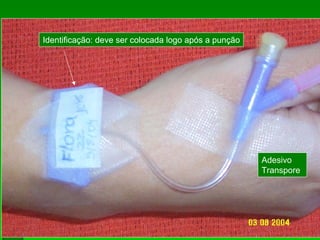 Identificação: deve ser colocada logo após a punção
Adesivo
Transpore
 
