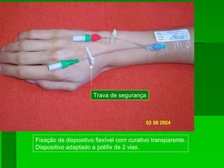 Fixação de dispositivo flexível com curativo transparente.
Dispositivo adaptado a polifix de 2 vias.
Trava de segurança
 