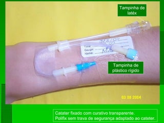 Catater fixado com curativo transparente.
Polifix sem trava de segurança adaptado ao cateter.
Tampinha de
plástico rígido
Tampinha de
latéx
 