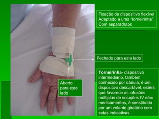 Fixação de dispositivo flexível
Adaptado a uma “torneirinha”.
Com esparadrapo
Fechado para este lado
Aberto
para este
lado
Torneirinha- dispositivo
intermediário, também
conhecido por dânula, é um
dispositivo descartável, estéril,
que favorece as infusões
múltiplas de soluções IV e/ou
medicamentos, é constituída
por um volante giratório com
setas indicativas.
 