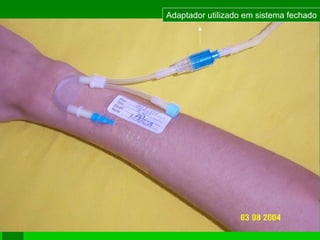 Adaptador utilizado em sistema fechado
 