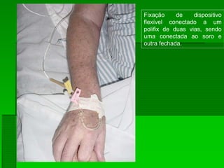 Fixação de dispositivo
flexível conectado a um
polifix de duas vias, sendo
uma conectada ao soro e
outra fechada.
 