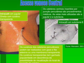 Intracath em jugular
Direita com curativo
transparente
Os cateteres centrais inseridos por
punção percutânea são procedimentos
médicos. As veias mais utilizadas são a
jugular e a subclavia.
Os curativos dos cateteres percutâneos
podem ser realizados com gaze e fita
adesiva ou uma membrana transparente.
Os curativos transparentes tem ganhado
popularidade em decorrência da
possibilidade de visualização do local de
inserção do cateter.
Intracath em subclavia E
Fonte: Weinstein, 2001.
 