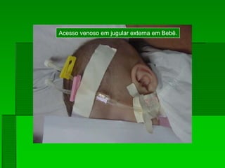 Acesso venoso em jugular externa em Bebê.
 