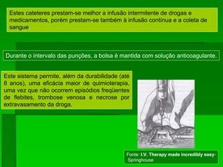 Estes cateteres prestam-se melhor a infusão intermitente de drogas e
medicamentos, porém prestam-se também à infusão contínua e a coleta de
sangue.
Durante o intervalo das punções, a bolsa é mantida com solução anticoagulante.
Este sistema permite, além da durabilidade (até
8 anos), uma eficácia maior de quimioterapia,
uma vez que não ocorrem episódios freqüentes
de flebites, trombose venosa e necrose por
extravasamento da droga.
Fonte: I.V. Therapy made incredibly easy-
Springhouse
 