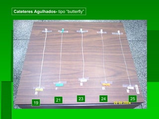 19
21 23 24 25
Cateteres Agulhados- tipo “butterfly”
 