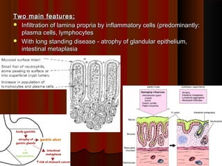 Two main features:Two main features:
 Infiltration of lamina propria by inflammatory cells (predominantly:Infiltration of lamina propria by inflammatory cells (predominantly:
plasma cells, lymphocytesplasma cells, lymphocytes
 With long standing disease - atrophy of glandular epithelium,With long standing disease - atrophy of glandular epithelium,
intestinal metaplasiaintestinal metaplasia
1414
 