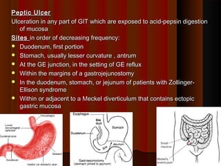 Peptic UlcerPeptic Ulcer
Ulceration in any part of GIT which are exposed to acid-pepsin digestionUlceration in any part of GIT which are exposed to acid-pepsin digestion
of mucosaof mucosa
SitesSites in order of decreasing frequency:in order of decreasing frequency:
 Duodenum, first portionDuodenum, first portion
 Stomach, usually lesser curvature , antrumStomach, usually lesser curvature , antrum
 At the GE junction, in the setting of GE refluxAt the GE junction, in the setting of GE reflux
 Within the margins of a gastrojejunostomyWithin the margins of a gastrojejunostomy
 In the duodenum, stomach, or jejunum of patients with Zollinger-In the duodenum, stomach, or jejunum of patients with Zollinger-
Ellison syndromeEllison syndrome
 Within or adjacent to a Meckel diverticulum that contains ectopicWithin or adjacent to a Meckel diverticulum that contains ectopic
gastric mucosagastric mucosa
1616
 
