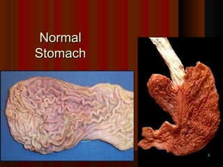 NormalNormal
StomachStomach
22
 