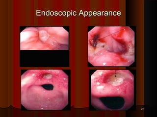 Endoscopic AppearanceEndoscopic Appearance
2121
 