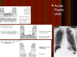 AcuteAcute
PepticPeptic
ulcerulcer
2222
 