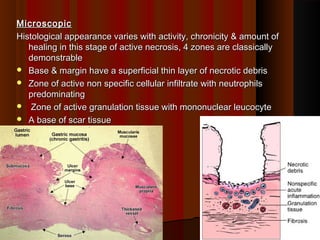 MicroscopicMicroscopic
Histological appearance varies with activity, chronicity & amount ofHistological appearance varies with activity, chronicity & amount of
healing in this stage of active necrosis, 4 zones are classicallyhealing in this stage of active necrosis, 4 zones are classically
demonstrabledemonstrable
 Base & margin have a superficial thin layer of necrotic debrisBase & margin have a superficial thin layer of necrotic debris
 Zone of active non specific cellular infiltrate with neutrophilsZone of active non specific cellular infiltrate with neutrophils
predominatingpredominating
 Zone of active granulation tissue with mononuclear leucocyteZone of active granulation tissue with mononuclear leucocyte
 A base of scar tissueA base of scar tissue
2626
 