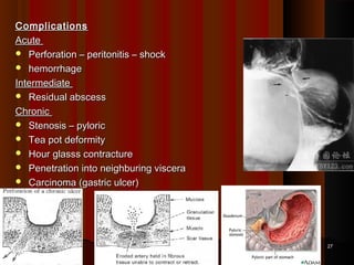ComplicationsComplications
AcuteAcute
 Perforation – peritonitis – shockPerforation – peritonitis – shock
 hemorrhagehemorrhage
IntermediateIntermediate
 Residual abscessResidual abscess
ChronicChronic
 Stenosis – pyloricStenosis – pyloric
 Tea pot deformityTea pot deformity
 Hour glasss contractureHour glasss contracture
 Penetration into neighburing visceraPenetration into neighburing viscera
 Carcinoma (gastric ulcer)Carcinoma (gastric ulcer)
  
2727
 