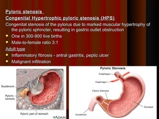 Pyloric stenosisPyloric stenosis
Congenital Hypertrophic pyloric stenosis (HPS)Congenital Hypertrophic pyloric stenosis (HPS)
Congenital stenosis of the pylorus due to marked muscular hypertrophy ofCongenital stenosis of the pylorus due to marked muscular hypertrophy of
the pyloric sphincter, resulting in gastric outlet obstructionthe pyloric sphincter, resulting in gastric outlet obstruction
 One in 300-900 live birthsOne in 300-900 live births
 Male-to-female ratio 3:1Male-to-female ratio 3:1
Adult typeAdult type
 Inflammatory fibrosis - antral gastritis, peptic ulcerInflammatory fibrosis - antral gastritis, peptic ulcer
 Malignant infiltrationMalignant infiltration
33
 