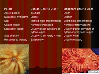 3030
Points Benign Gastric Ulcer Malignant gastric ulcer
Age of patient Younger Older
Duration of symptoms Longer Shorter
Sex Marked male predominance Slight male predominance
Gastric acidity Normal or increased Normal or totally absent
Location of lesion Usually lesser curvature of
pyloric region
Usually greater curvature of
pyloric or prepyloric region
Size of lesion Usually <2 cm rarely > 4cm Usually >4cm
Response to therapy Satisfactory Usually refactory
 