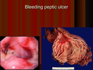 Bleeding peptic ulcerBleeding peptic ulcer
3131
 