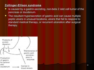 Zollinger-Ellison syndromeZollinger-Ellison syndrome
 Is caused by a gastrin-secreting, non-beta 2 islet cell tumor of theIs caused by a gastrin-secreting, non-beta 2 islet cell tumor of the
pancreas or duodenum.pancreas or duodenum.
 The resultant hypersecretion of gastric acid can cause multipleThe resultant hypersecretion of gastric acid can cause multiple
peptic ulcers in unusual locations, ulcers that fail to respond topeptic ulcers in unusual locations, ulcers that fail to respond to
standard medical therapy, or recurrent ulceration after surgicalstandard medical therapy, or recurrent ulceration after surgical
therapy.therapy.
3232
 