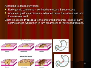 According to depth of invasionAccording to depth of invasion
 Early gastric carcinoma – confined to mucosa & submucosaEarly gastric carcinoma – confined to mucosa & submucosa
 Advanced gastric carcinoma – extended below the submucosa intoAdvanced gastric carcinoma – extended below the submucosa into
the muscular wallthe muscular wall
Gastric mucosalGastric mucosal dysplasiadysplasia is the presumed precursor lesion of earlyis the presumed precursor lesion of early
gastric cancer, which then in turn progresses to "advanced" lesions.gastric cancer, which then in turn progresses to "advanced" lesions.
3636
 