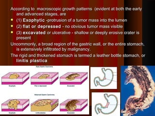 According to macroscopic growth patterns (evident at both the earlyAccording to macroscopic growth patterns (evident at both the early
and advanced stages, areand advanced stages, are
 (1)(1) ExophyticExophytic -protrusion of a tumor mass into the lumen-protrusion of a tumor mass into the lumen
 (2)(2) flat or depressedflat or depressed - no obvious tumor mass visible- no obvious tumor mass visible
 (3)(3) excavatedexcavated or ulcerative - shallow or deeply erosive crater isor ulcerative - shallow or deeply erosive crater is
presentpresent
Uncommonly, a broad region of the gastric wall, or the entire stomach,Uncommonly, a broad region of the gastric wall, or the entire stomach,
is extensively infiltrated by malignancy.is extensively infiltrated by malignancy.
The rigid and thickened stomach is termed a leather bottle stomach, orThe rigid and thickened stomach is termed a leather bottle stomach, or
linitis plasticalinitis plastica
3737
 