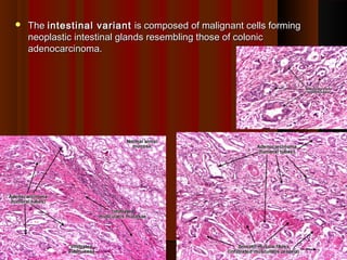  TheThe intestinal variantintestinal variant is composed of malignant cells formingis composed of malignant cells forming
neoplastic intestinal glands resembling those of colonicneoplastic intestinal glands resembling those of colonic
adenocarcinoma.adenocarcinoma.
3939
 