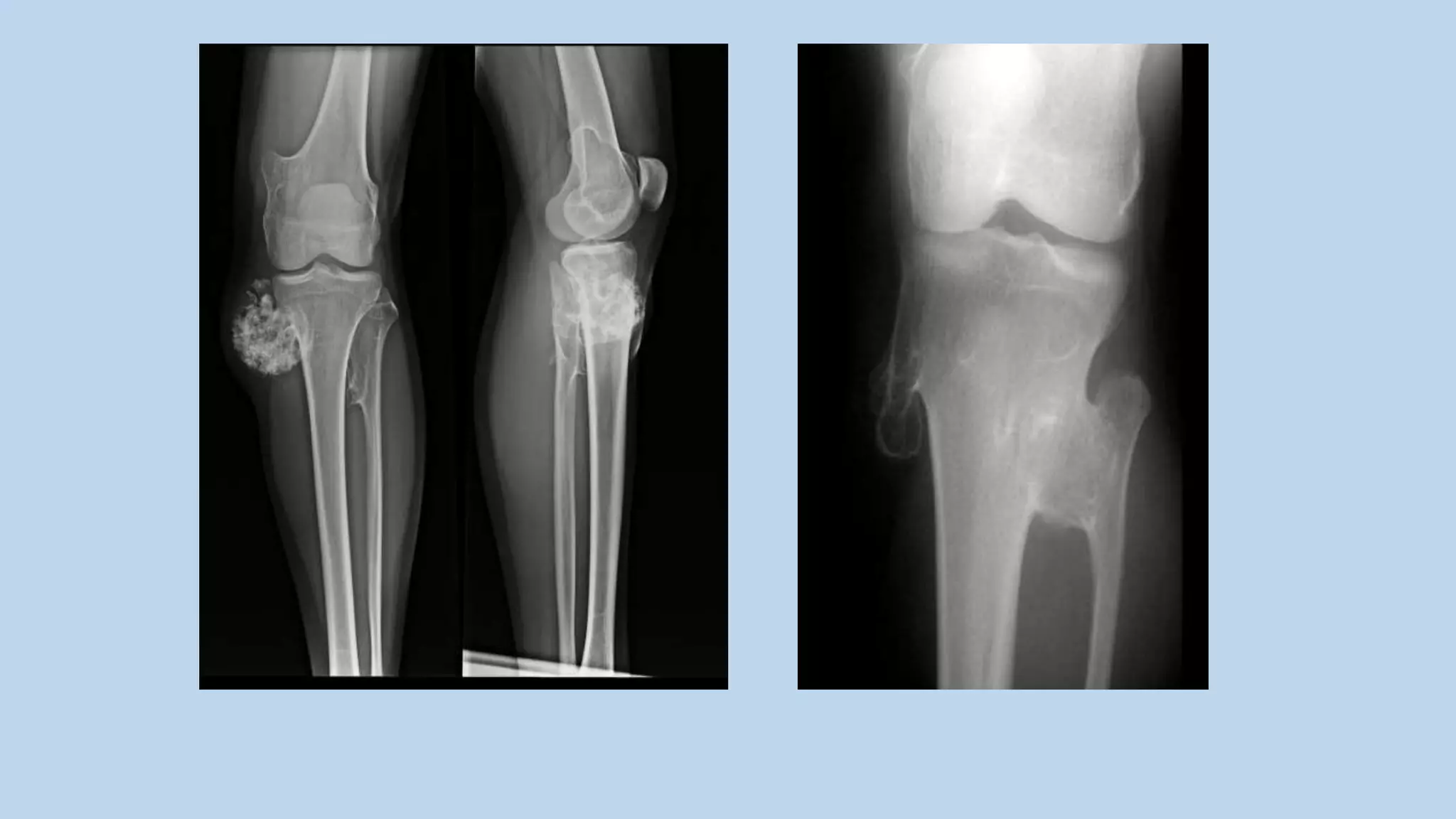 Radiological approach to benign bone tumours | PPTX