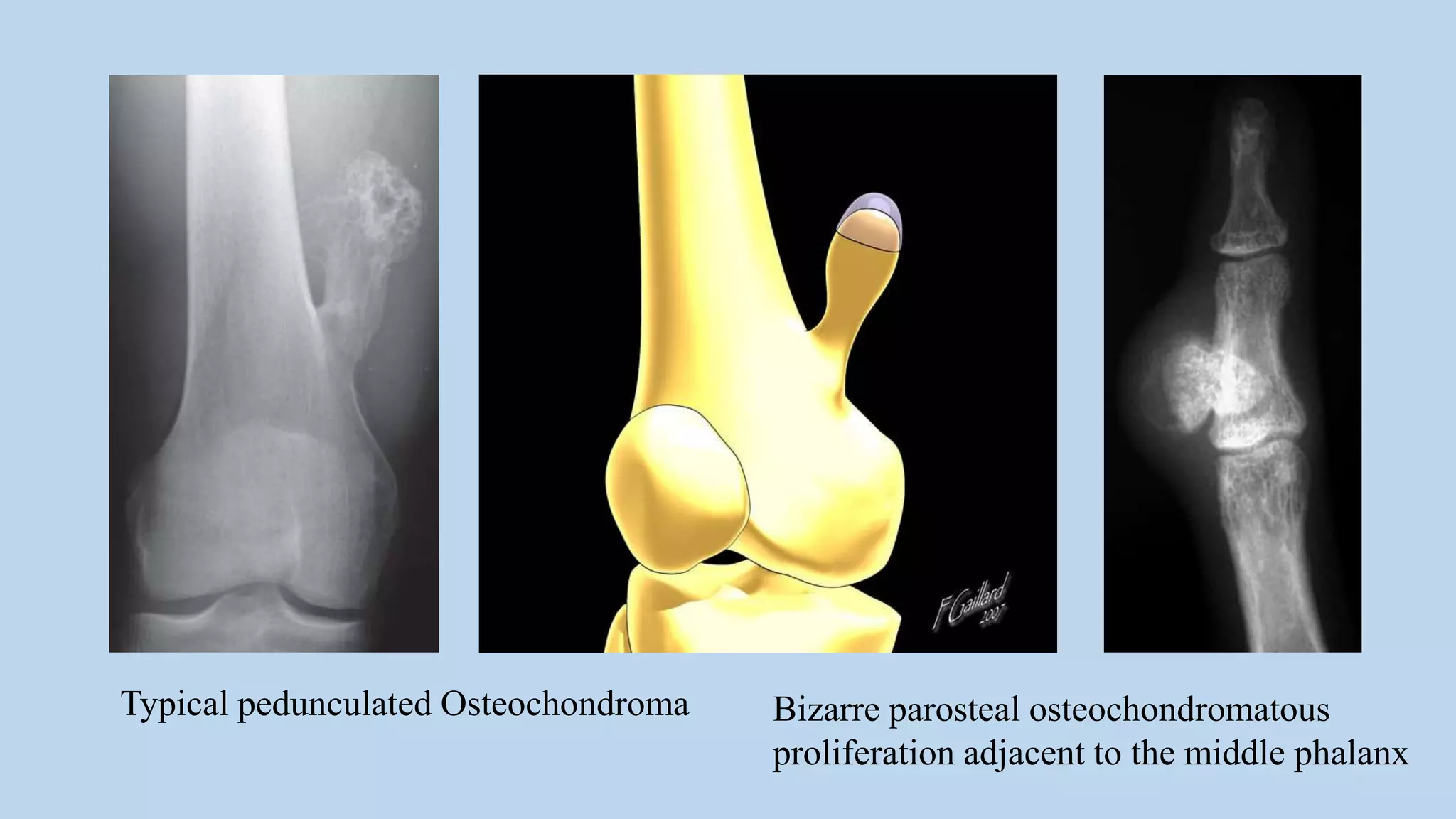 Radiological approach to benign bone tumours | PPTX