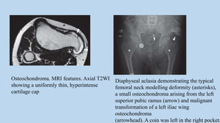 Osteochondroma. MRI features. Axial T2WI
showing a uniformly thin, hyperintense
cartilage cap
Diaphyseal aclasia demonstrating the typical
femoral neck modelling deformity (asterisks),
a small osteochondroma arising from the left
superior pubic ramus (arrow) and malignant
transformation of a left iliac wing
osteochondroma
(arrowhead). A coin was left in the right pocket.
 