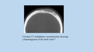 Coronal CT multiplanar reconstruction showing
a haemangioma of the skull vault.*
 