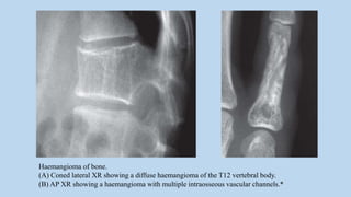Haemangioma of bone.
(A) Coned lateral XR showing a diffuse haemangioma of the T12 vertebral body.
(B) AP XR showing a haemangioma with multiple intraosseous vascular channels.*
 