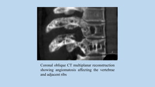 Coronal oblique CT multiplanar reconstruction
showing angiomatosis affecting the vertebrae
and adjacent ribs
 