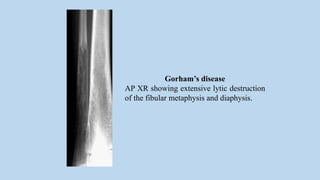 Gorham’s disease
AP XR showing extensive lytic destruction
of the fibular metaphysis and diaphysis.
 