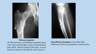 Fibrous dysplasia
AP XR showing a well-defined expanded lesion
with typical ground-glass matrix mineralization
and a thick, sclerotic margin (rind sign). A stress
fracture is present in the lateral cortex (arrow).*
Osteofibrous dysplasia of the tibial shaft.
Multicystic lesion surrounded by sclerotic bone.
 