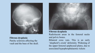 Fibrous dysplasia
Patchy sclerosis affecting the
vault and the base of the skull.
Fibrous dysplasia
Radiolucent areas in the femoral necks
and pelvic bones.
Bilateral coxa vara. This is an early
‘shepherd’s crook’ deformity. Widening of
the upper femoral epiphyseal plates, due to
associated hypophosphataemic rickets
 