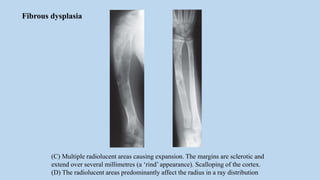 (C) Multiple radiolucent areas causing expansion. The margins are sclerotic and
extend over several millimetres (a ‘rind’ appearance). Scalloping of the cortex.
(D) The radiolucent areas predominantly affect the radius in a ray distribution
Fibrous dysplasia
 
