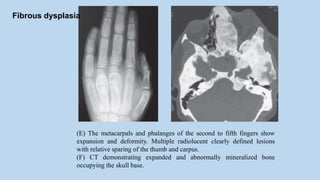 (E) The metacarpals and phalanges of the second to fifth fingers show
expansion and deformity. Multiple radiolucent clearly defined lesions
with relative sparing of the thumb and carpus.
(F) CT demonstrating expanded and abnormally mineralized bone
occupying the skull base.
Fibrous dysplasia
 