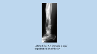 Lateral tibial XR showing a large
implantation epidermoid.*
 