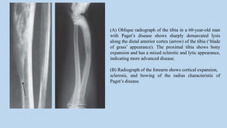 (A) Oblique radiograph of the tibia in a 60-year-old man
with Paget’s disease shows sharply demarcated lysis
along the distal anterior cortex (arrow) of the tibia (‘blade
of grass’ appearance). The proximal tibia shows bony
expansion and has a mixed sclerotic and lytic appearance,
indicating more advanced disease.
(B) Radiograph of the forearm shows cortical expansion,
sclerosis, and bowing of the radius characteristic of
Paget’s disease.
 