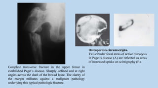 Complete transverse fracture in the upper femur in
established Paget’s disease. Sharply defined and at right
angles across the shaft of the bowed bone. The clarity of
the margin militates against a malignant pathology
underlying this typical pathologic fracture.
Osteoporosis circumscripta.
Two circular focal areas of active osteolysis
in Paget’s disease (A) are reflected as areas
of increased uptake on scintigraphy (B).
 