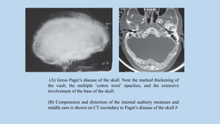 (A) Gross Paget’s disease of the skull. Note the marked thickening of
the vault, the multiple ‘cotton wool’ opacities, and the extensive
involvement of the base of the skull.
(B) Compression and distortion of the internal auditory meatuses and
middle ears is shown on CT secondary to Paget’s disease of the skull.#
 