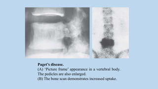 Paget’s disease.
(A) ‘Picture frame’ appearance in a vertebral body.
The pedicles are also enlarged.
(B) The bone scan demonstrates increased uptake.
 