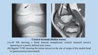 Cortical desmoid (Bufkin lesion).
(A) AP XR showing a distal femoral metaphyseal cortical desmoid (arrow)
appearing as a poorly defined lytic lesion.
(B) Sagittal T1WI showing the lesion (arrow) at the site of origin of the medial head
of gastrocnemius (arrowhead).
 