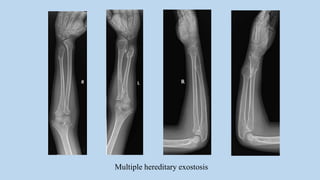 Multiple hereditary exostosis
 